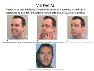 VII: FACIAL
Alteração da sensibilidade / Dor pavilhão auricular / aumento da audição /
alterações no paladar / dificuldade fechamento ocular/ Assimetria de face
 