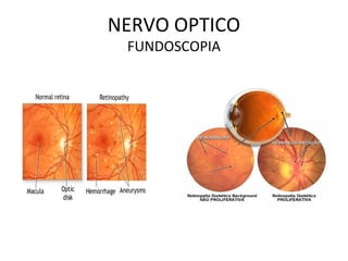 NERVO OPTICO
FUNDOSCOPIA
 