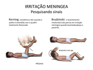 IRRITAÇÃO MENINGEA
Pesquisando sinais
Kerning: resistência e dor quando o
joelho é estendido com o quadril
totalmente flexionado
Brudzinski: o levantamento
involuntário das pernas em irritação
meníngea quando levantadacabeça o
paciente.
 