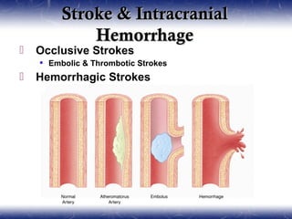 Stroke & Intracranial
             Hemorrhage
   Occlusive Strokes
     Embolic & Thrombotic Strokes
   Hemorrhagic Strokes
 