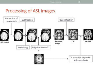 Neurology advanced asl jy gauvrit | PDF