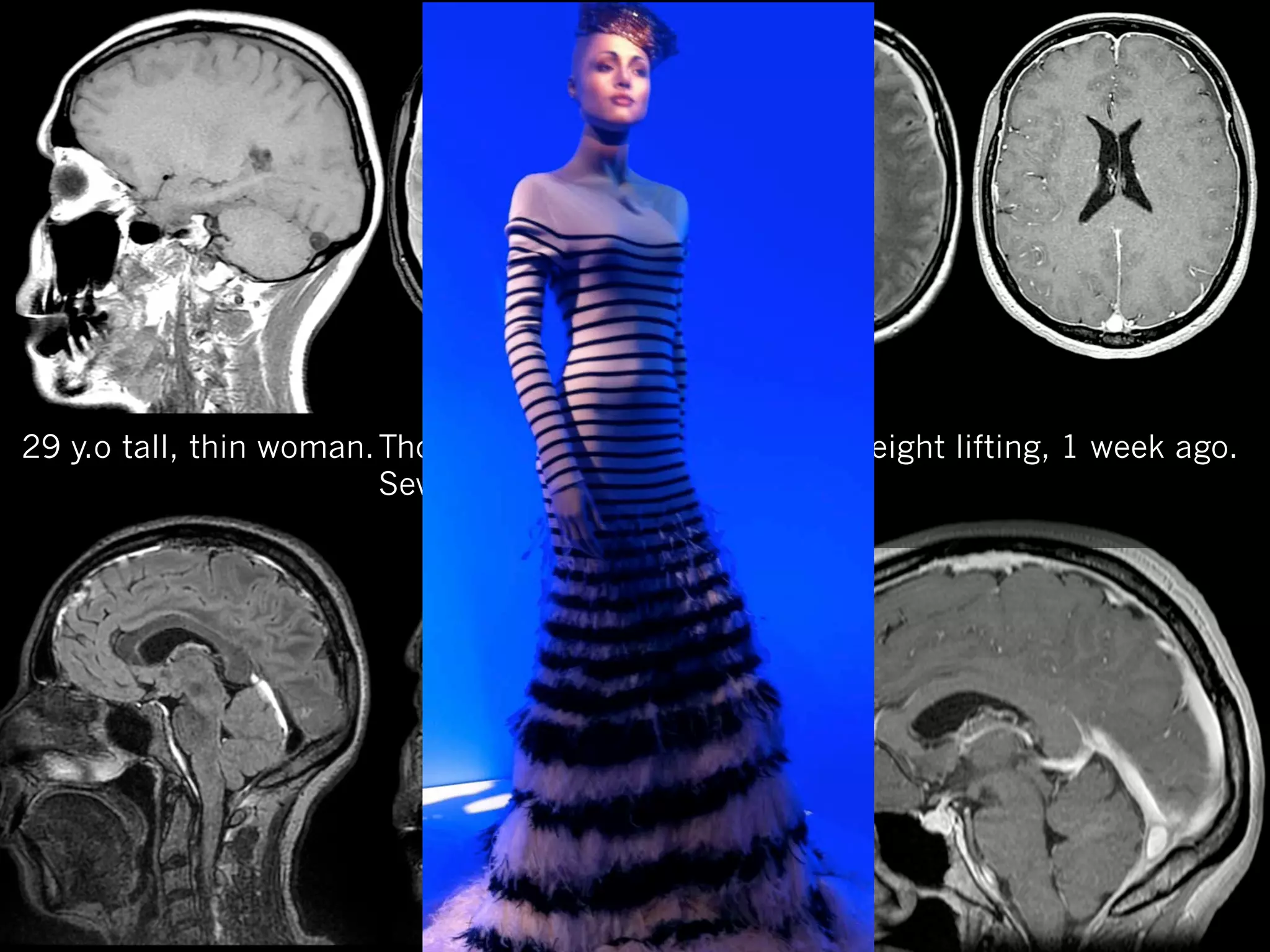 29 y.o tall, thin woman. Thoracic back pain after heavy weight lifting, 1 week ago.
Severe daylies Headaches

 