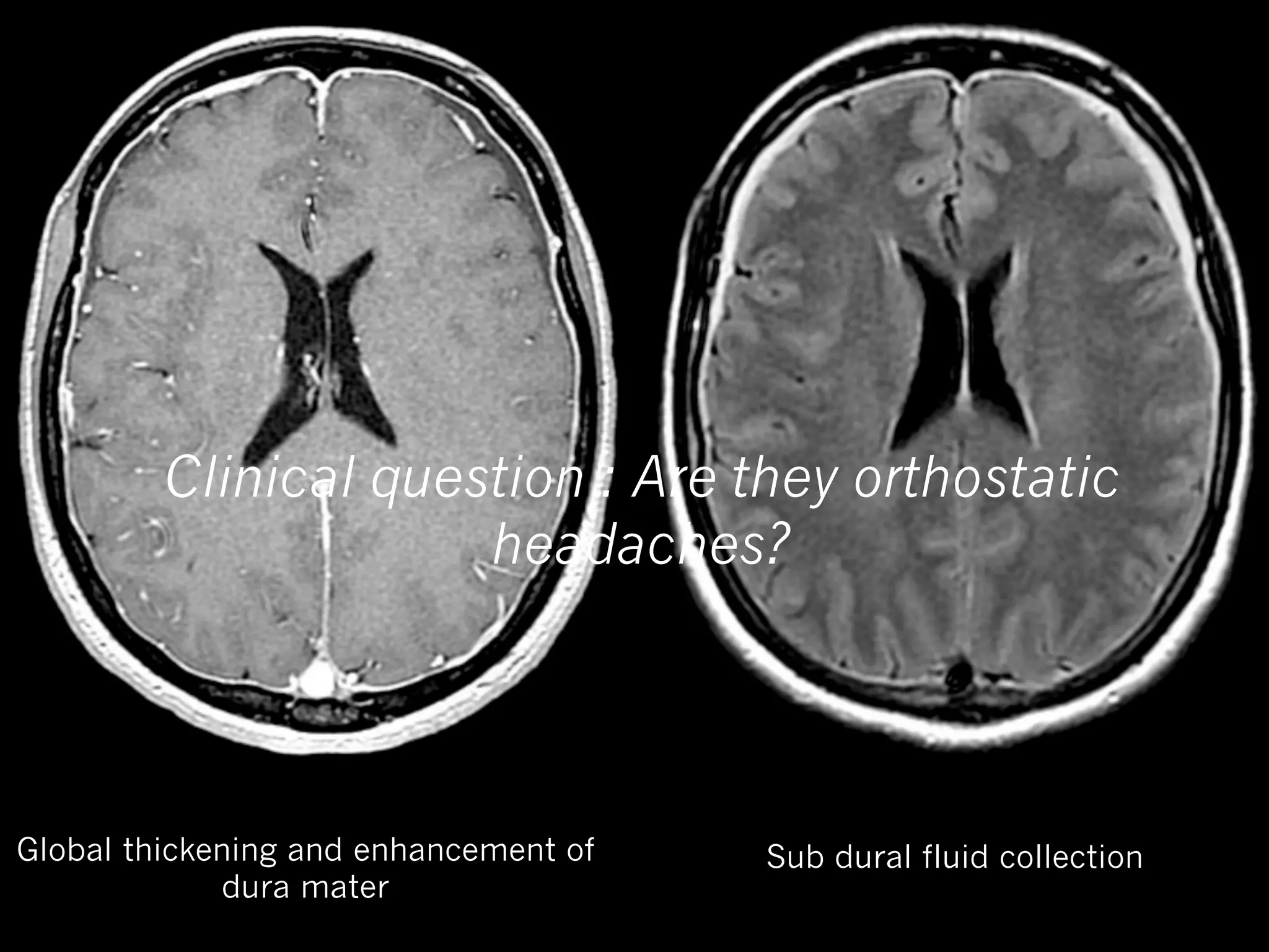 Clinical question : Are they orthostatic
headaches?

Global thickening and enhancement of
dura mater

Sub dural fluid collection

 