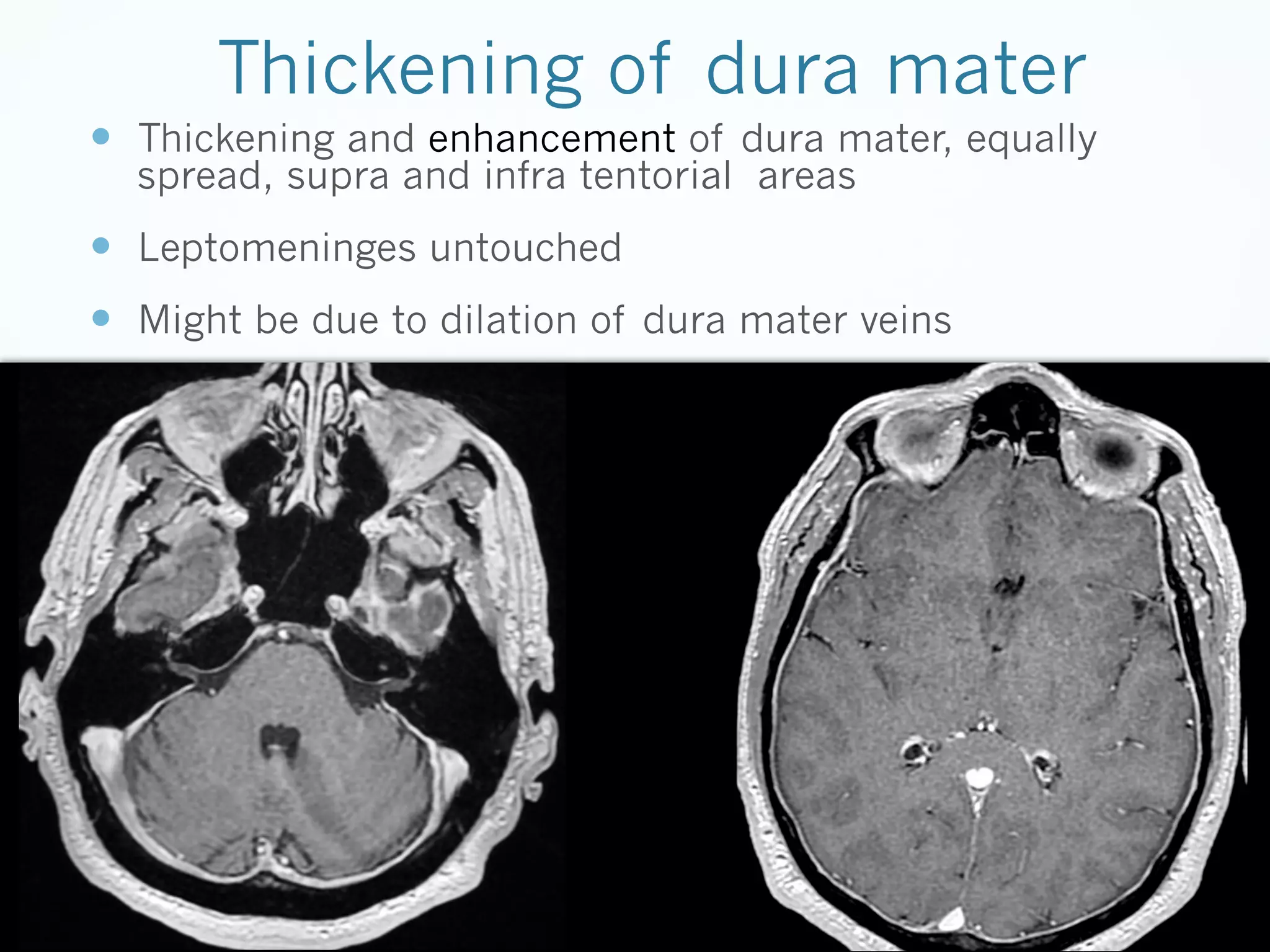 Thickening of dura mater
—  Thickening and enhancement of dura mater, equally
spread, supra and infra tentorial areas

—  Leptomeninges untouched
—  Might be due to dilation of dura mater veins

 