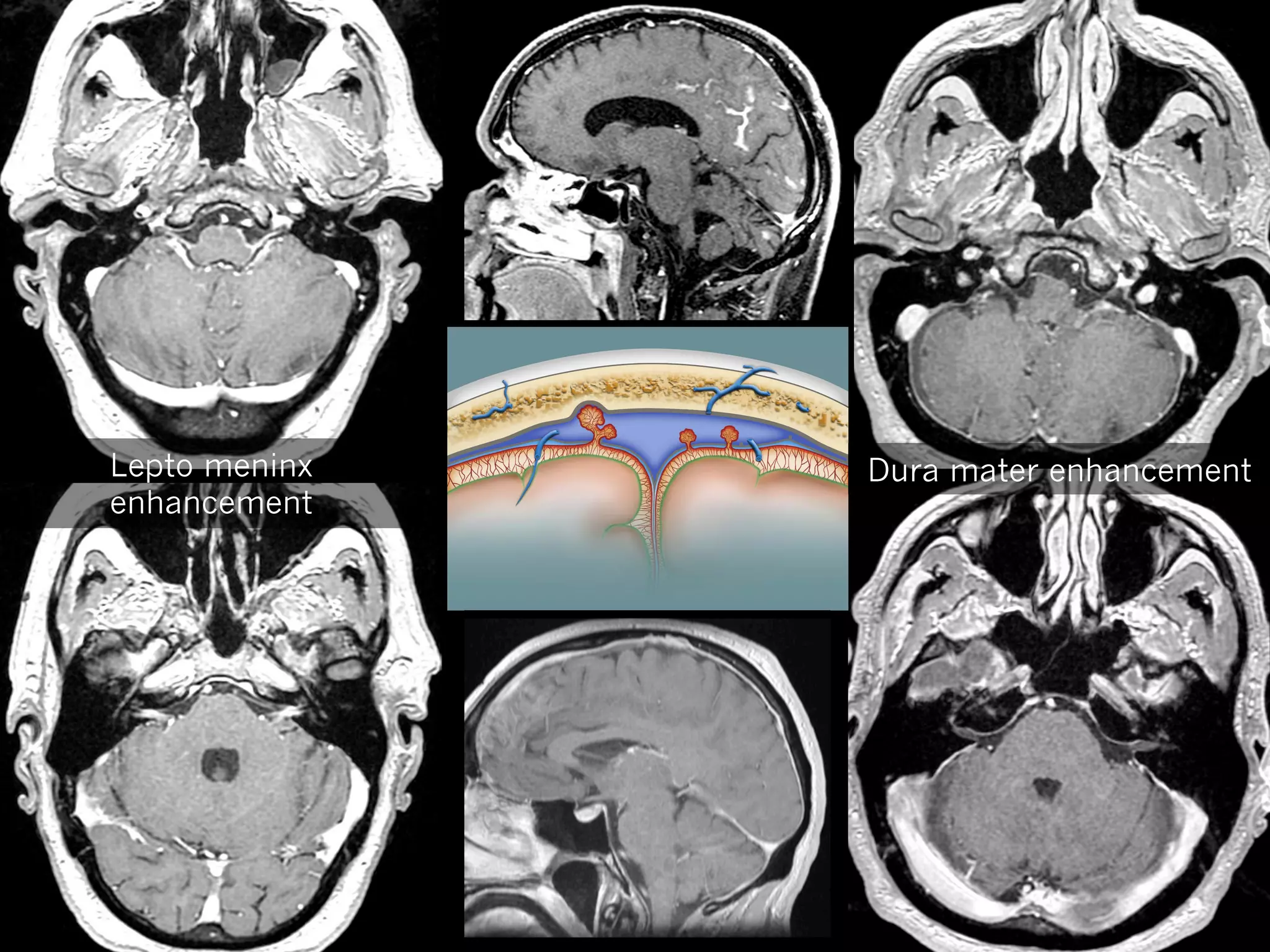 Lepto meninx
enhancement

Dura mater enhancement

 