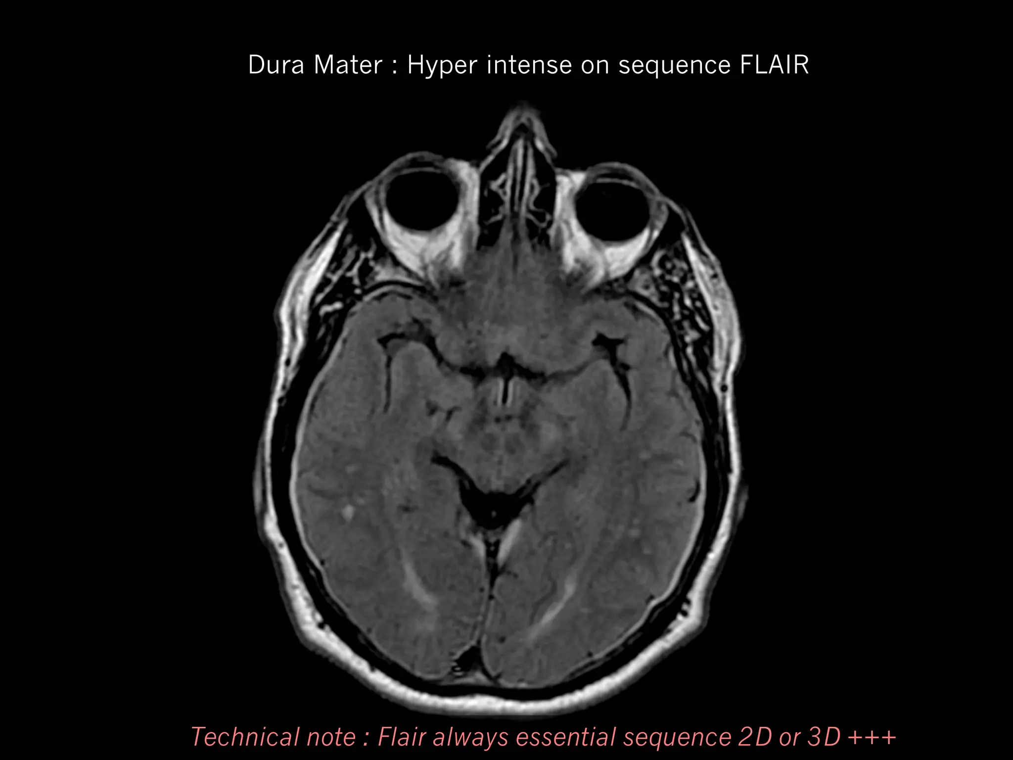 Dura Mater : Hyper intense on sequence FLAIR

Technical note : Flair always essential sequence 2D or 3D +++

 