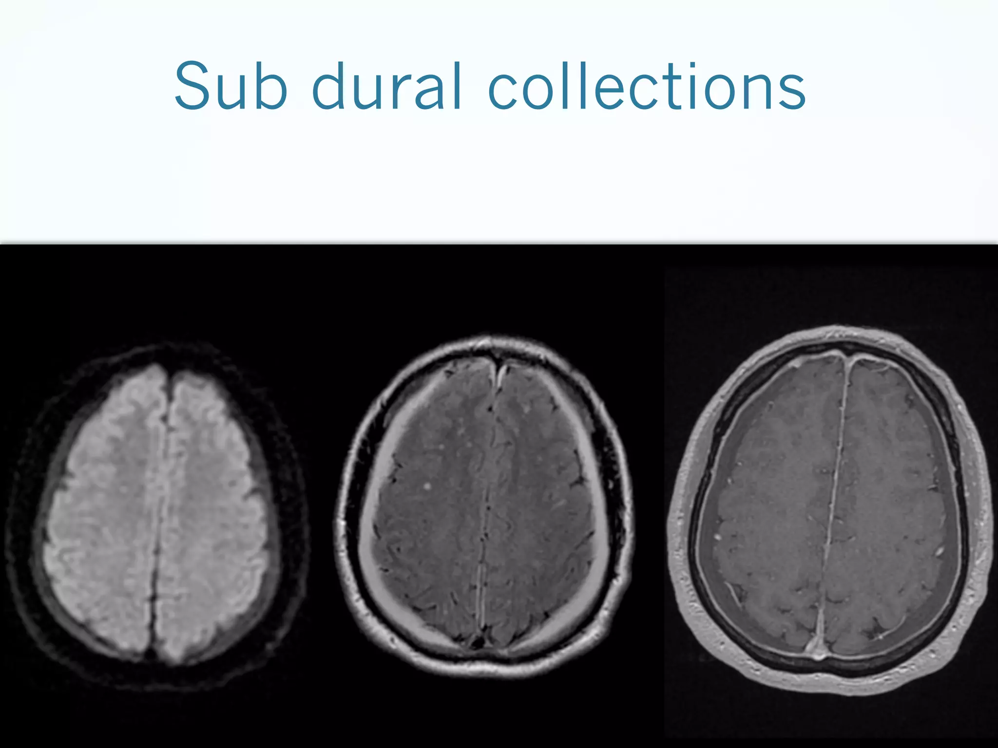Sub dural collections

 