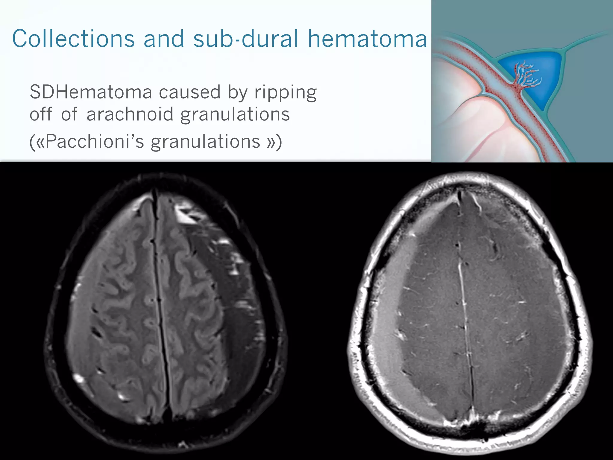 Collections and sub-dural hematoma
SDHematoma caused by ripping
off of arachnoid granulations
(«Pacchioni’s granulations ») 

 