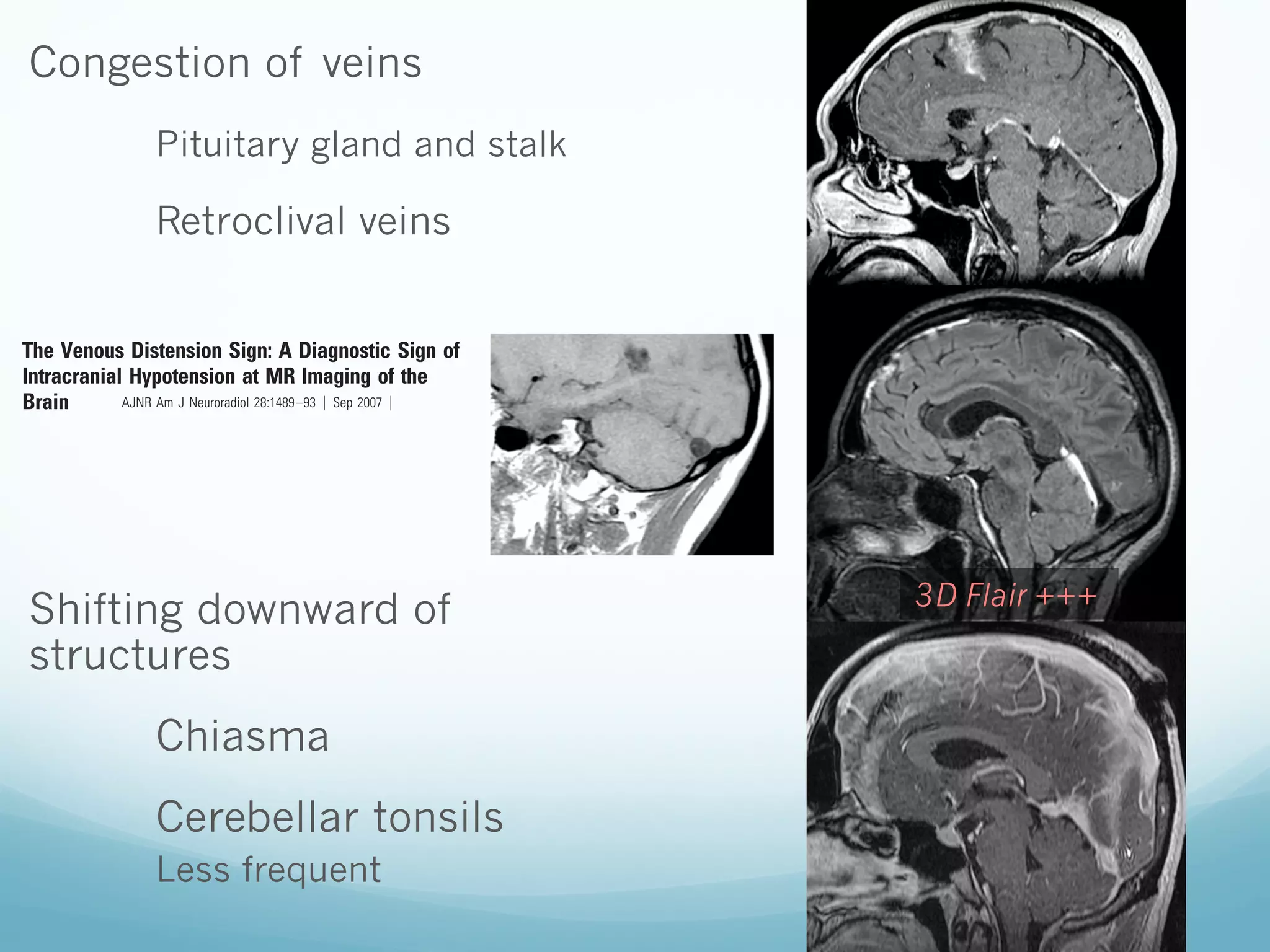 brain. In paompensate for
henomenon is
ts in a characThis contour
verse sinus on
s of the brain.
inary fashion.
agittal images
ansverse sinus

include the following: diffuse headache that worsens within 15 minutes
after sitting or standing; evidence of low CSF pressure on MR imaging;
and spontaneous headache resolution or within several days after epidural blood patch (EBP). Fifteen IH patients (IHPs) with complete MR
imaging at presentation were identified and included 13 women and 2
men with an overall average age of 46 years. Of the 15 patients with
confirmed IH, 12 presented with primary SIH, 2 presented after lumbar
puncture, and 1 after a spinal anesthetic procedure. All 15 of the IHPs
provided the typical clinical presentation of orthostatic headaches, as well
as characteristic findings at gadolinium-enhanced MR imaging of the
brain. Nine of the 15 went on to have EBP treatment, 4 had spontaneous
resolution of their symptoms, and 2 were lost to follow-up. Follow-up
MR imaging of the brain was available in 10 of the 15 IHPs.

Congestion of veins

7.

Division of Neurontario, Canada; and
uebec, Canada.

niversity of Toronto.

Pituitary gland and stalk

Retroclival veins

Control Patients

Eighty consecutive potential control patients (CPs) were recruited
from the population of cancer patients at our institution who were
undergoing screening for intracranial metastatic
Venous Distension Sign: A DiagnosticofSigndisease. These
of
patients had no clinical signs or symptoms neurologic disease.

logy, Department of
New East Wing 3MC
.farb@utoronto.ca

The
Intracranial Hypotension at MR Imaging of the
AJNR Am J Neuroradiol 28:1489 –93 ͉ Sep 2007 ͉ www.ajnr.org
Brain

1489

BACKGROUND AND PURPOSE: Patients with intracranial hypotension (IH) demonstrate intracranial venous
enlargement with a characteristic change in contour of the transverse sinus seen on routine T1-weighted
sagittal imaging. In IH, the inferior margin of the midportion of the dominant transverse sinus acquires a
distended convex appearance; we have termed this the venous distension sign (VDS). This is distinct from
the normal appearance of this segment, which usually has a slightly concave or straight lower margin. This
sign is introduced, and its performance as a test for the presence of this disease is evaluated.
MATERIALS AND METHODS: The transverse sinuses on T1-weighted sagittal imaging of 15 patients
with IH and 15 control patients were independently assessed in a blinded fashion by 3 readers for the
presence of a VDS. A present or absent VDS was determined for each patient by each reader, and a
consensus result for each patient was determined by unanimity or majority rule.
RESULTS: Using the VDS, the readers correctly identified 93% (14 of 15) of the IH patients and
similarly 93% (14 of 15) of the control patients. There was a high rate of agreement among the readers
for the interpretation of the VDS (multirater ␬ ϭ 0.82). The overall sensitivity of the VDS for the
diagnosis of intracranial hypotension was 94%. Specificity was also 94%.

3D Flair +++

Shifting downward of
structures

CONCLUSION: The VDS appears to be an accurate test for the presence or absence of IH and may be
helpful in the evaluation of these patients.

normally has a concave or straight inferior border (Fig 1). In cases
of IH, the inferior border acquires a distended appearance with a
convex bulging of its inferior border (a VDS, as in Figs 2 and 3).
The purpose of this paper is to report this sign and evaluate its
performance in a controlled trial for identifying patients with IH
and differentiating them from normal age- and sex-matched
control subjects.

Chiasma

BRAIN

(IH) is a syndrome of variable etiions, and MR imaging appearances
e of CSF volume depletion and retic pressure.1-7 The syndrome of
ypically presents with orthostatic
MR findings and most commonly
leak of CSF from the spinal thecal
include “over shunting” associated
ures, as well as continued leaks after
mbar punctures. Many characterisassociated with IH regardless of its

Cerebellar tonsils
Materials and Methods

Patients with IH

Less frequent

maging of patients presenting to our
identified a highly reliable novel imof IH. We have termed this sign the
VDS) and evaluated for it on routine
eighted imaging of the brain. In pauses enlarge as they compensate for
volume.2,7,13,14 This phenomenon is

A retrospective review of clinical and imaging records was carried out to
identify patients evaluated for IH at our institution from February 2001
to September 2005. Criteria used in this study to firmly establish the
diagnosis of IH were similar to those reported previously for SIH2,15 and
include the following: diffuse headache that worsens within 15 minutes
after sitting or standing; evidence of low CSF pressure on MR imaging;

ORIGINAL RESEARCH

Institutional review board approval was obtained for this project.

 