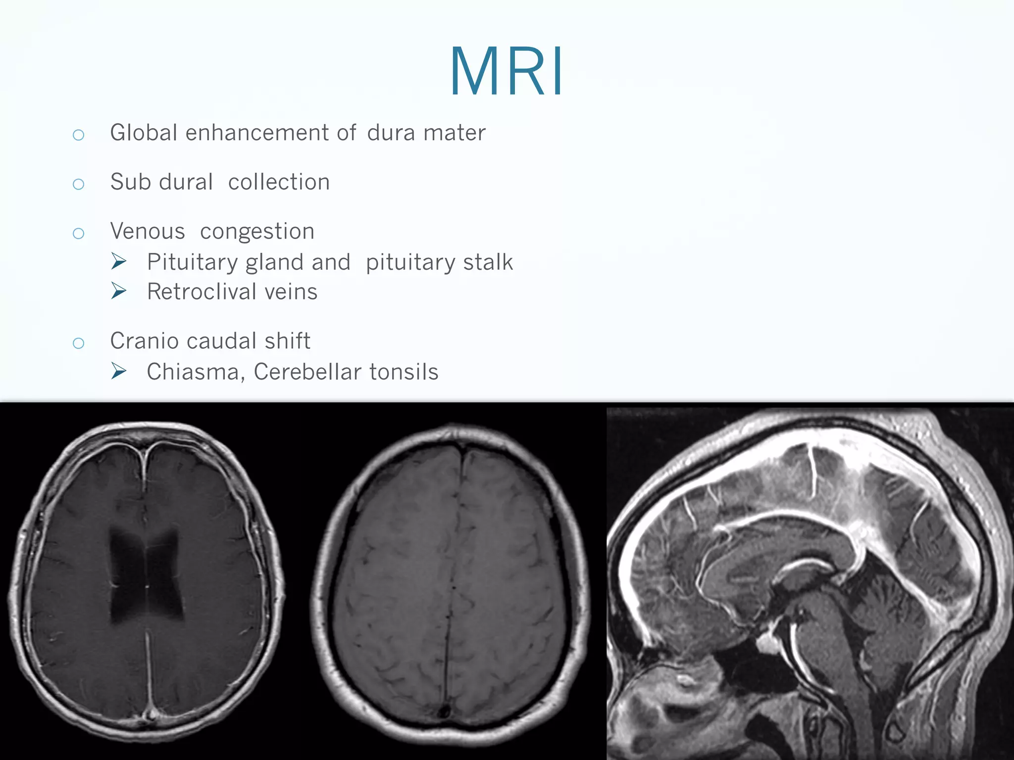 MRI
o  Global enhancement of dura mater
o  Sub dural collection
o  Venous congestion
Ø  Pituitary gland and pituitary stalk
Ø  Retroclival veins
o  Cranio caudal shift
Ø  Chiasma, Cerebellar tonsils

 