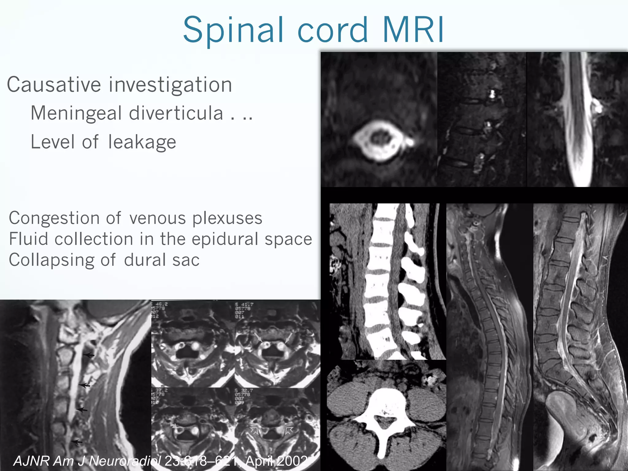 Spinal cord MRI
Causative investigation
Meningeal diverticula . ..
Level of leakage

Congestion of venous plexuses
Fluid collection in the epidural space
Collapsing of dural sac

AJNR Am J Neuroradiol 23:618–621, April 2002

 