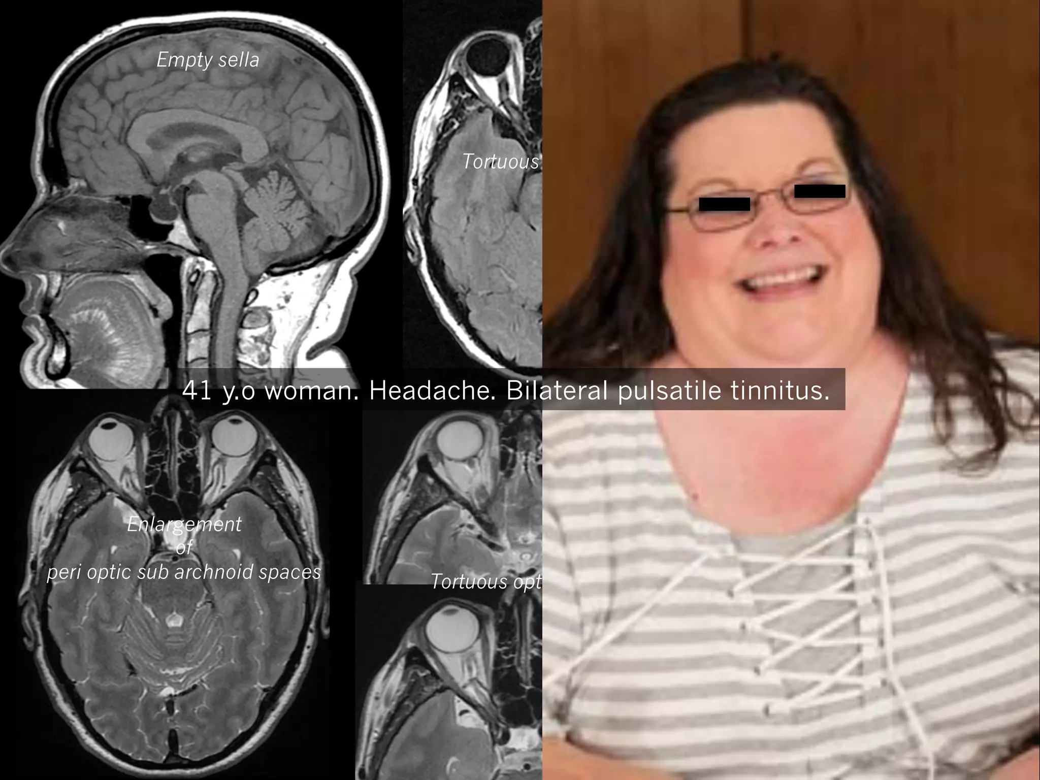 Empty sella

Thin Ventricles

Tortuous optic nerves

41 y.o woman. Headache. Bilateral pulsatile tinnitus.

Enlargement
of
peri optic sub archnoid spaces

Tortuous optic nerves

Enlargement
of
peri optic sub archnoid spaces

 