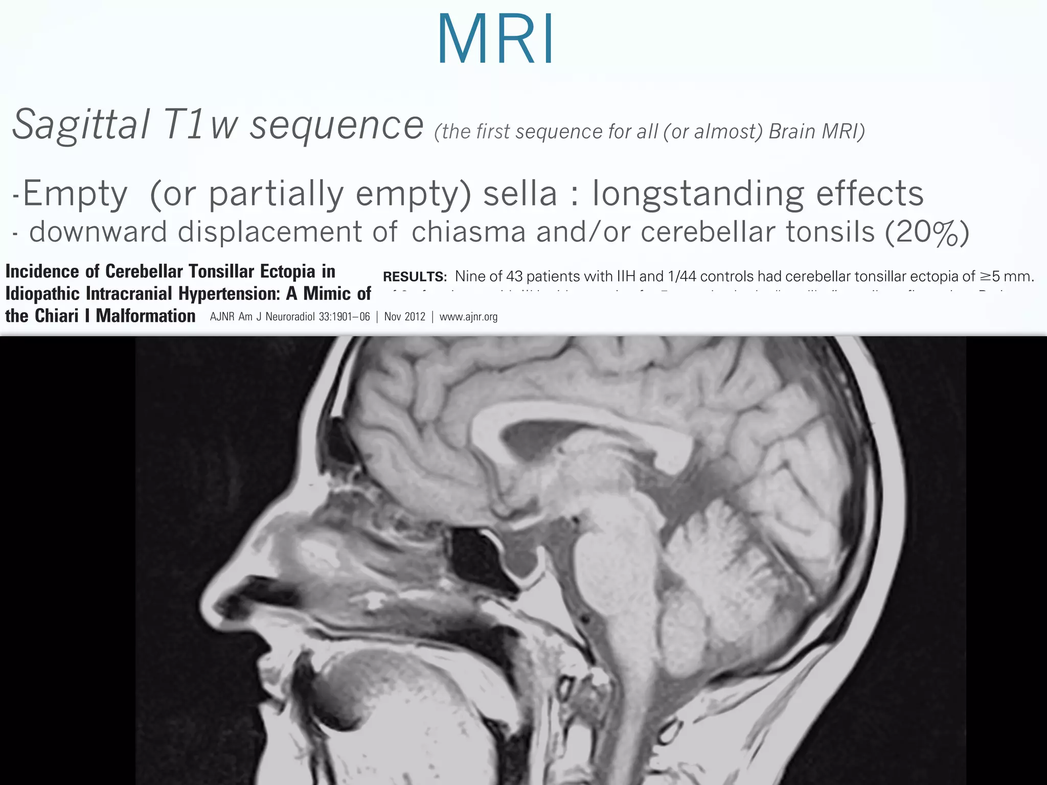 de pain, pulsatile tinnitus, and vin lead to blindness.2,5 Treatment
n, acetazolamide, and surgical inhunt surgery.6-8
l diagnosis based on normal CSF
d opening pressure (Ͼ20 cm H2O
25 cm H2O in obese patients with
pportive neuroimaging findings

the Chiari I Malformation

with tonsillar ectopia, such as Chiari I malformation and
RESEARCH
spontaneous intracranial hypotension.
Chiari I malformation is characterized by caudal protrusion of “peg-shaped” cerebellar tonsils below the foramen.11,12
A.H. Aiken
BACKGROUND
Chiari I malformation is defined radiographically AND infeas an PURPOSE: IIH is a syndrome of elevated intracranial pressure without hydrocep
alus, mass,Ն5 mm below
or identifiable cause. Diagnosis is made by clinical presentation, intracranial pressu
rior displacement of the cerebellar tonsils of
J.A. Hoots
the opisthion-basion line.13,14 Inmeasurement, cerebellar
the healthy adult, and supportive imaging findings. A subset of patients with IIH may have tonsil
A.M. Saindane
tonsils are rarely Ͼ3 mm below the foramen magnum. Paectopia, meeting the criteria for Chiari malformation type I but not responding to surgical decompre
P.A. Hudgins
tients with the radiographic appearancefor(the I malformasion of Chiari first sequenceof this study almost) Brain MRI)
Chiari I. The purpose for all (or was to determine the incidence and morphology
tion can be asymptomatic, but the most common clinical
cerebellar tonsillar ectopia in patients with IIH.
symptoms include headache, neck pain, vertigo, sensory
changes, and poor coordination. Therefore, clinical symptoms
MATERIALS AND METHODS: Forty-three patients with clinically confirmed IIH and 44 age-match
may overlap IIH.11 Chiari I malformation is also associated
controls were included. Two neuroradiologists with CAQs reviewed sagittal T1-weighted MRI in
with abnormal CSF flow, which can lead to syringomyelia.
blinded surgical and measured cerebellar tonsil and obex positions relative to the foramen magnum a
Treatment of Chiari I consists primarily offashion hindbrain
prepontine to restore nordecompression with suboccipital craniectomy cistern width at the level of the midpons.
mal flow at the foramen magnum.15
Tonsillar Ectopia in
RESULTS: Nine of subset
Previous studies in the surgical literature describe a 43 patients with IIH and 1/44 controls had cerebellar tonsillar ectopia of Ն5 mm. Fi

MRI

Sagittal T1w sequence

ter revision January 12, 2012.

-Empty (or partially empty) sella : longstanding effects

d Imaging Sciences, Emory University, Atlanta,

ual Meeting of the American Society of Neurorangton.

- downward displacement of chiasma and/or cerebellar tonsils (20%)

ey H. Aiken, MD, Radiology Department, Emory
Suite BG 26, Atlanta, GA 30322; e-mail:

Incidence of Cerebellar
Idiopathic Intracranial Hypertension: A Mimic of of 9 of patients with IIH with ectopia of Ն5 mm also had a “peglike” tonsil configuration. Patients w
Nov had significantly lower
the Chiari I Malformation AJNR Am J Neuroradiol 33:1901– 06 ͉ IIH 2012 ͉awww.ajnr.org 1901 tonsillar position (2.1 Ϯ 2.8 mm) than age-matched controls (0.7 Ϯ1.9 m

P Ͻ .05). The obex position was significantly lower in patients with IIH versus controls (Ϫ7.9 m
[above the FM] versus Ϫ9.4 mm [above the FM], P Ͻ .05). The prepontine width was not significan
different between the groups.

BACKGROUND AND PURPOSE: IIH is a syndrome of elevated intracranial pressure without hydrocephalus, mass, or identifiable cause. Diagnosis is made by clinical presentation, intracranial pressure
measurement, and supportive imaging findings. A subset of patients with IIH may have tonsillar
ectopia, meeting the criteria for Chiari malformation type I but not responding to surgical decompression for Chiari I. The purpose of this study was to determine the incidence and morphology of
cerebellar tonsillar ectopia in patients with IIH.

CONCLUSIONS: Cerebellar tonsil position in patients with IIH was significantly lower than that

MATERIALS AND METHODS: Forty-three patients with clinically confirmed IIH and 44 age-matched

age-matched controls, often times peglike, mimicking Chiari I. A significantly lower obex positi
suggests an inferiorly displaced brain stem and cerebellum. When tonsillar ectopia of Ͼ5 mm
RESULTS: Nine of 43 patients with IIH and 1/44 controls had cerebellar tonsillar ectopia of Ն5 mm. Five
identified, imaging and clinical consideration of IIH are warranted to avoid misdiagnosis as Chiari I

controls were included. Two neuroradiologists with CAQs reviewed sagittal T1-weighted MRI in a
blinded fashion and measured cerebellar tonsil and obex positions relative to the foramen magnum and
prepontine cistern width at the level of the midpons.
of 9 of patients with IIH with ectopia of Ն5 mm also had a “peglike” tonsil configuration. Patients with
IIH had a significantly lower tonsillar position (2.1 Ϯ 2.8 mm) than age-matched controls (0.7 Ϯ1.9 mm,
P Ͻ .05). The obex position was significantly lower in patients with IIH versus controls (Ϫ7.9 mm
[above the FM] versus Ϫ9.4 mm [above the FM], P Ͻ .05). The prepontine width was not significantly
different between the groups.
CONCLUSIONS: Cerebellar tonsil position in patients with IIH was significantly lower than that in

ABBREVIATIONS: CAQ ϭ Certificate of Added Qualification; CM ϭ Chiari malformation; FM ϭ
foramen magnum; ICP ϭ intracranial pressure; IIH ϭ idiopathic intracranial hypertension

(

age-matched controls, often times peglike, mimicking Chiari I. A significantly lower obex position
suggests an inferiorly displaced brain stem and cerebellum. When tonsillar ectopia of Ͼ5 mm is
identified, imaging and clinical consideration of IIH are warranted to avoid misdiagnosis as Chiari I.

I

ABBREVIATIONS: CAQ ϭ Certificate of Added Qualification; CM ϭ Chiari malformation; FM ϭ
foramen magnum; ICP ϭ intracranial pressure; IIH ϭ idiopathic intracranial hypertension

BRAIN

9,10

ORIGINAL RESEARCH

seudotumor cerebri, is a synated ICP with normal CSF comble cause.1 It has been proposed
elated to decreased CSF resorpoutflow and elevated venous
y still surrounds the significance
H as the cause or the result of
antly affects young overweight
en with a reported incidence of
2,3
Patients with IIH most comes, occurring in 68%–98%.2,4

IH, previously known as pseudotumor cerebri, is a syndrome characterized by elevated ICP with normal CSF com1
have been described. Theseno other identifiable cause. It has been proposed
position and include flattening of the posterior
sclera, tortuosity of the optic nerve sheath, empty sella synthat the elevated ICP venous be related to decreased CSF resorpdrome, and stenosis of the transverse may sinuses.
Therefore, imaging can aid in making or supporting the clintion due to impaired venous outflow and elevated venous
ical diagnosis in some cases, especially if clinicians are not as
familiar with the diagnosis. The incidence and morphology of
pressure; however, controversy still surrounds the significance
cerebellar tonsillar ectopia in IIH has not been previously described in the radiology literature, to our knowledge. IIH as the cause or the result of
of venous sinus stenosis in When
present, tonsillar ectopia in IIH may confuse the radiographic
elevated ICP.2 IIH commonly associated
picture and mimic other entities more predominantly affects young overweight
with tonsillar ectopia, such as Chiari I malformation and

have been described. These include flattening of the posteri
sclera, tortuosity of the optic nerve sheath, empty sella sy
drome, and stenosis of the transverse venous sinuses.9
Therefore, imaging can aid in making or supporting the cli
ical diagnosis in some cases, especially if clinicians are not
familiar with the diagnosis. The incidence and morphology
cerebellar tonsillar ectopia in IIH has not been previously d
scribed in the radiology literature, to our knowledge. Wh

 