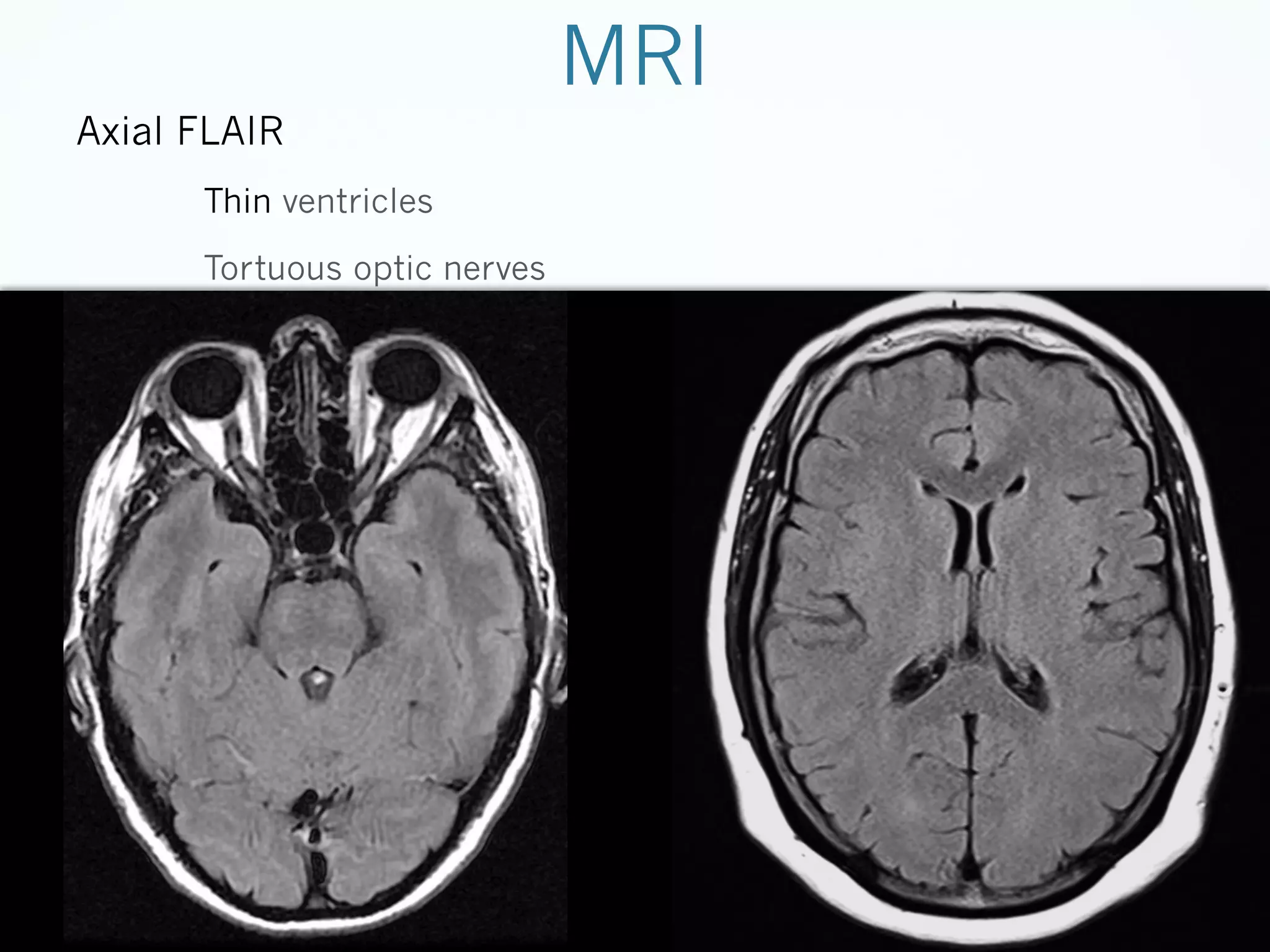 MRI
Axial FLAIR
Thin ventricles
Tortuous optic nerves

 