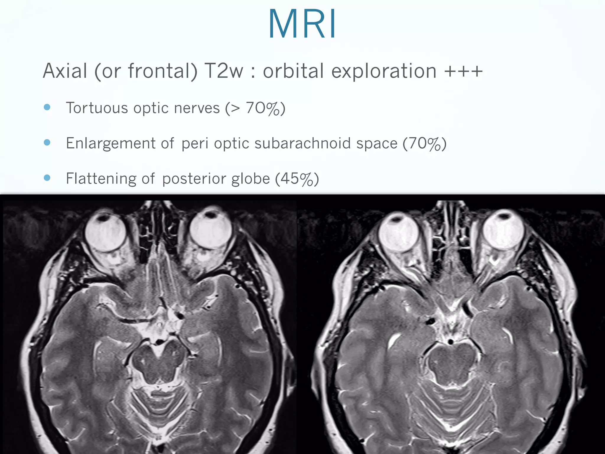 MRI
Axial (or frontal) T2w : orbital exploration +++
—  Tortuous optic nerves (> 7O%)
—  Enlargement of peri optic subarachnoid space (70%)
—  Flattening of posterior globe (45%)

 