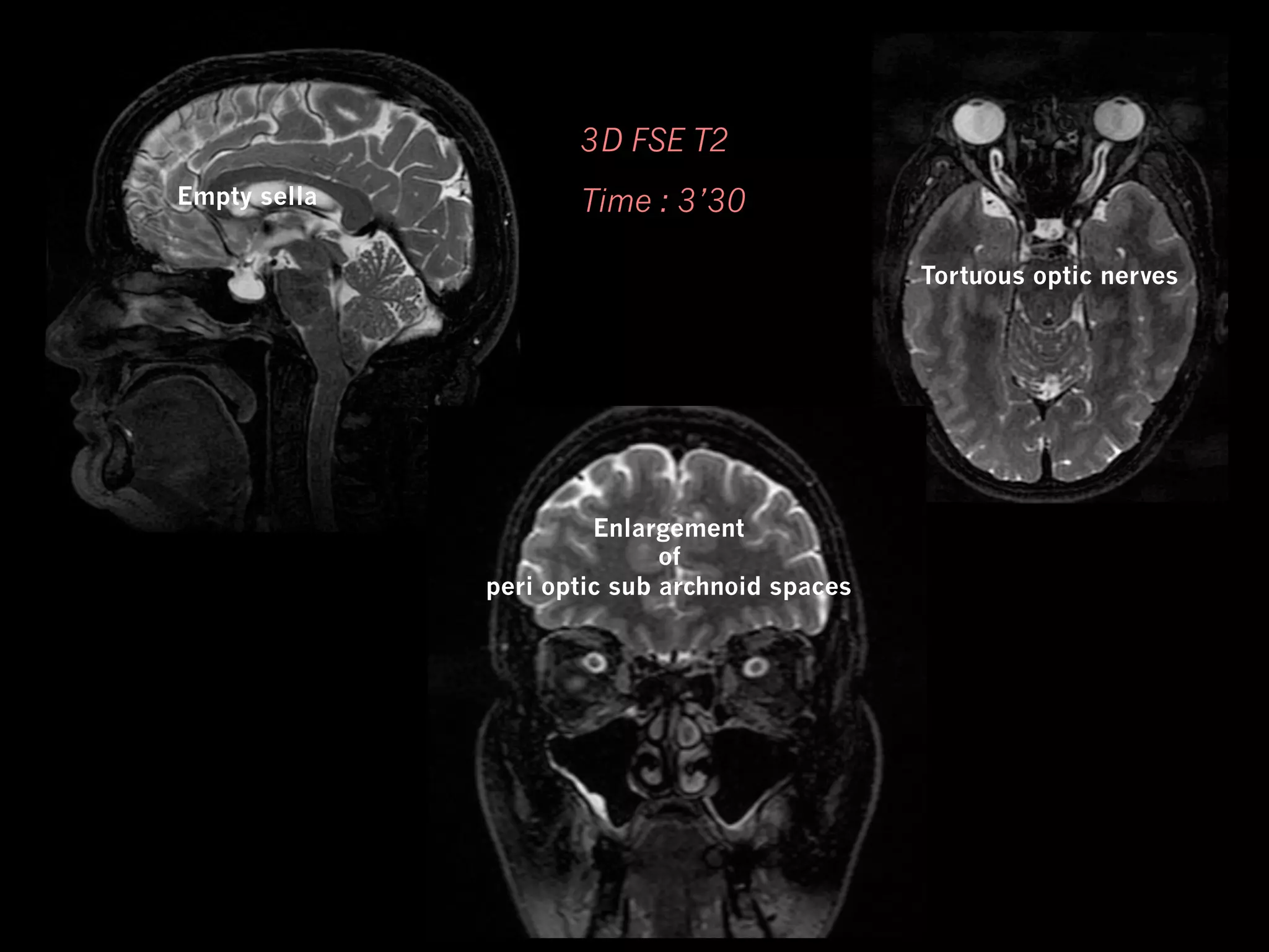 3D FSE T2
Empty sella

Time : 3’30
Tortuous optic nerves

Enlargement
of
peri optic sub archnoid spaces

 