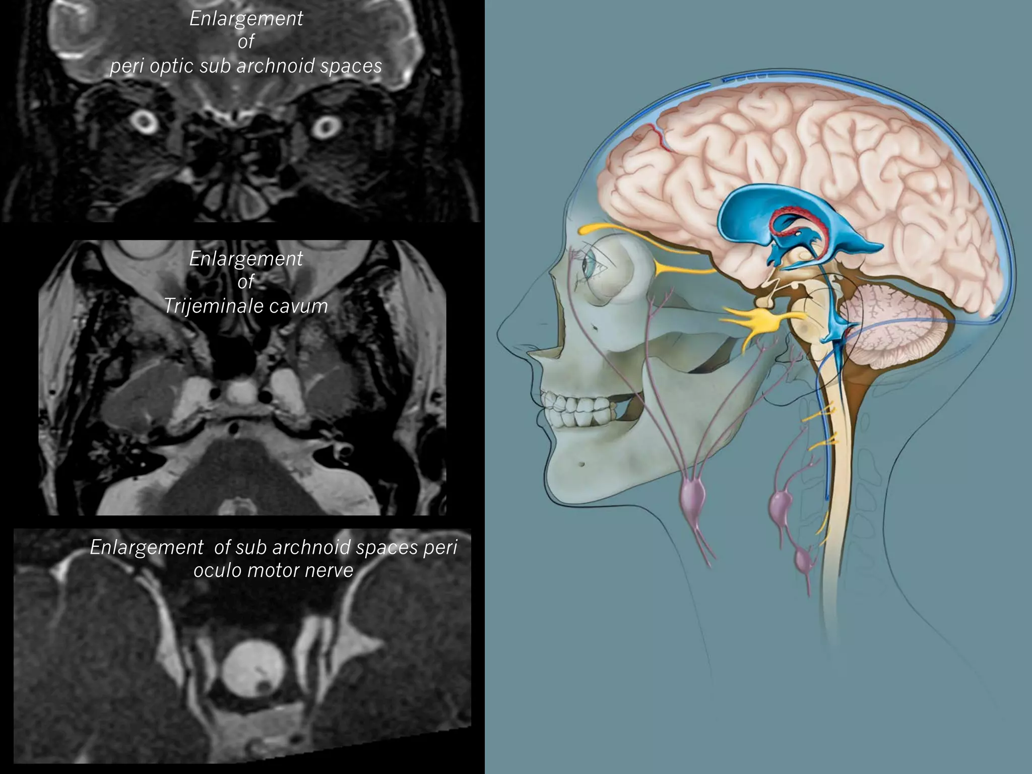 Enlargement
of
peri optic sub archnoid spaces

Enlargement
of
Trijeminale cavum

Enlargement of sub archnoid spaces peri
oculo motor nerve

 