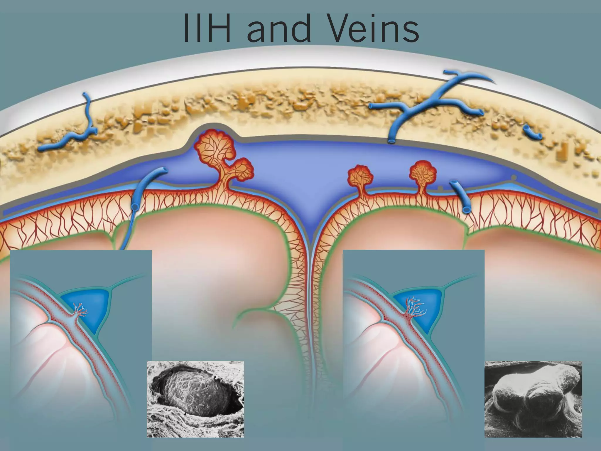 IIH and Veins

 