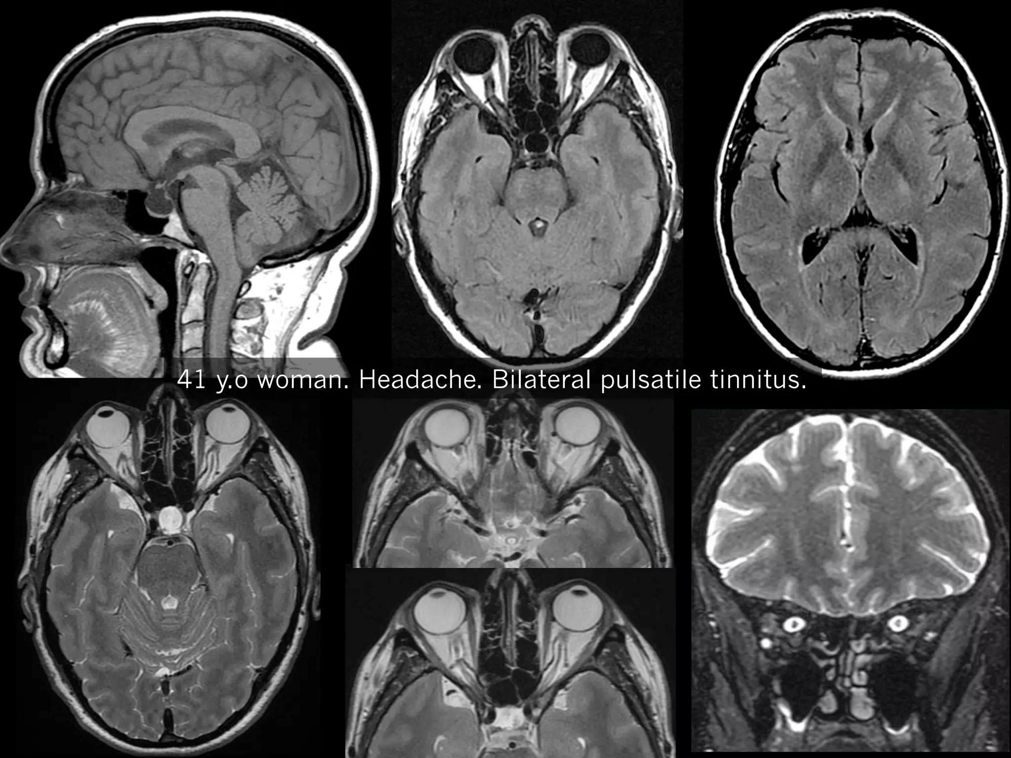 41 y.o woman. Headache. Bilateral pulsatile tinnitus.

 