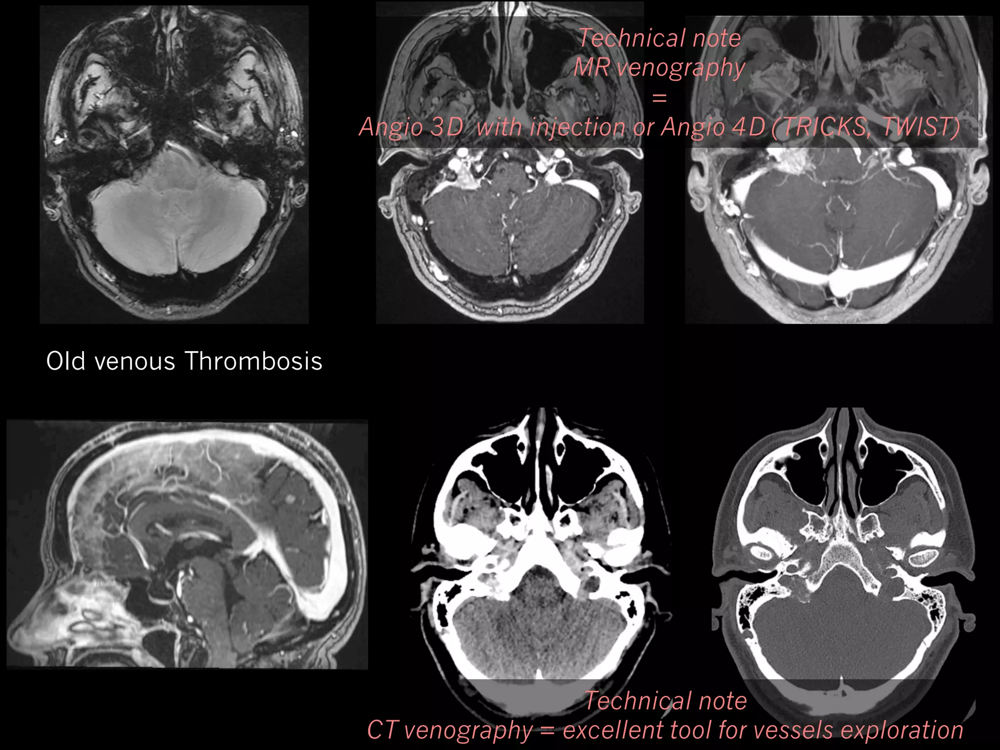 Technical note
MR venography
=
Angio 3D with injection or Angio 4D (TRICKS, TWIST)

Old venous Thrombosis

Technical note
CT venography = excellent tool for vessels exploration

 