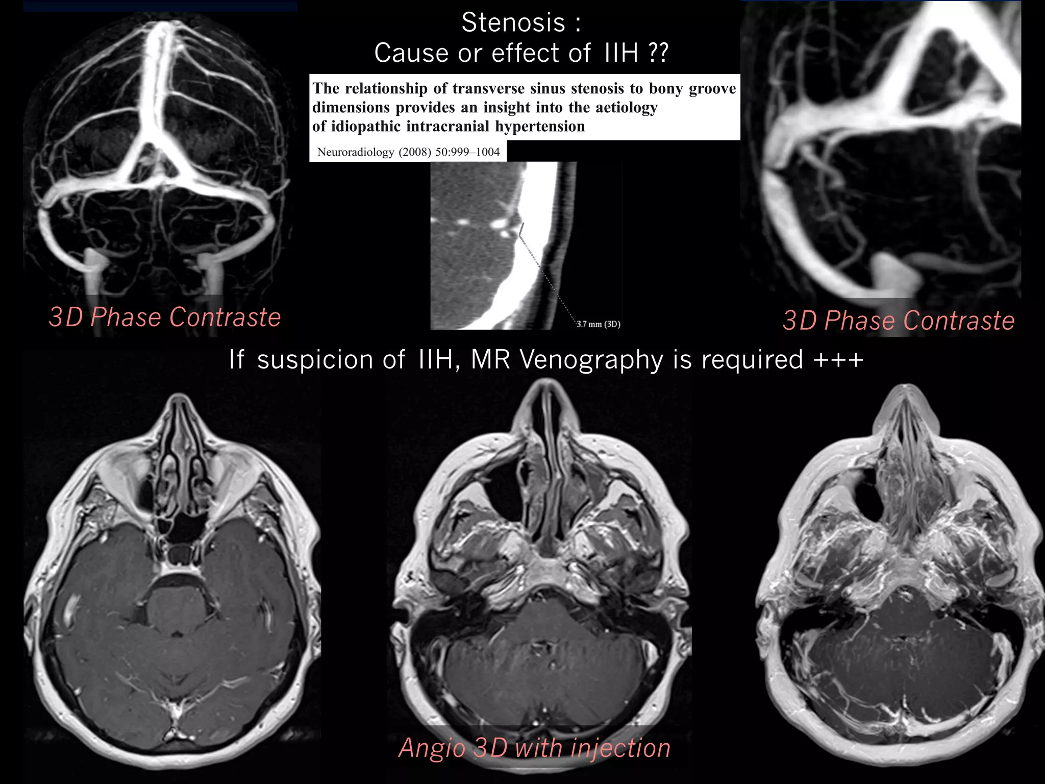 Stenosis :
Cause or effect of IIH ??

Neuroradiology (2008) 50:999–1004
DOI 10.1007/s00234-008-0431-5

DIAGNOSTIC NEURORADIOLOGY

The relationship of transverse sinus stenosis to bony groove
dimensions provides an insight into the aetiology
Neuroradiology (2008) 50:999–1004
of idiopathic intracranial hypertension

1003

Neuroradiology (2008) 50:999–1004
S. E. J. Connor & M. A. Siddiqui & V. R. Stewart &
E. A. M. O’Flynn
DOI 10.1007/s00234-008-0431-5

DIAGNOSTIC NEURORADIOLOGY
Received: 20 March 2008 / Accepted: 25 June 2008 / Published online: 12 July 2008
# Springer-Verlag 2008

3D Phase Contraste

subjects. There were a further 8/23 cases where the small or
Abstract
Introduction Transverse sinus tapered narrowings are freabsent sinus was associated with an absent bony groove.
Conclusion Transverse sinus tapered narrowings in subjects
quently identified in patients with idiopathic intracranial
without IIH and in the majority of patients with IIH were
hypertension (IIH); however, it remains unclear whether
associated with proportionately small or absent grooves,
they are primary stenoses or whether they occur secondary
and these are postulated to be primary or fixed. Some
to raised cerebrospinal fluid pressure. Computed tomopatients with IIH demonstrate tapered transverse sinus
graphic venography demonstrates both the morphology of
stenoses with disproportionately large bony grooves,
the venous system and the adjacent bony grooves so it may
occipital bone in an
Fig. 6 Reformatted image
suggesting secondary bone in an
provide an insight into the aetiologya of these transverse perpendicular toathe occipitalor acquired narrowing. This implies IIH subject at areamin demonstrates narrowing
IIH subject at areamin demonstrates narrowing withfor heightbone to sinus stenoses bone to heightsinus ratio of 1.6
a varied aetiology a the transverse with a heightof IIH.
sinus stenoses.
S. E. and methods Tapered A. Siddiquib,& cV.
heightsinus ratio of 2.2.
Reformatted images perpendicular to the
Materials J. Connor & M.transverse sinus narrow- R. Stewart &
ings (>50%) were studied in 19 patients without IIH and 14
Keywords Idiopathic intracranial hypertension . Computed
E. A. M. O’Flynn
further 8/23 cases where tomographic absent sinus was
actually stenosis
patients with IIH. Computed tomography vascular studies the small orvenography . Venous sinus . Vascularrepresents an expected increase in size of a primary
were reviewed and the dimensions of the with ansinuses bony groove. It is of note that
associated venous absent
narrowing as per the Monro–Kellie hypothesis. Studying
and bony grooves at the sites of maximum and stenoses have only previously been studied
venous sinuses minimum
the adjacent bony groove may provide further insight into
transverse sinus area dimensions weretime of clinical presentation or following intervention
Introduction
at the recorded.
the pre-morbid venous sinus appearances in such cases.
Results There was demonstrated to be a strong correlation
such as CSF drainage. It is possible that the observed July The
Received: 20 March 2008 / Accepted: 25 June 2008 / Publishedsinus stenoses are detectedstudy may be criticised since observers were not
online: 12
2008on neuroof bony groove height with venous sinus height at the
Bilateral transverse
“reversibility” of stenoses by lowering intracranial pressure
blinded with respect to the identification of IIH and non-IIH
# Springer-Verlag 2008
largest portions of the transverse sinus in both IIH patients
imaging studies in the majority of patients with idiopathic
data. these stenoses
and non-IIH subjects as well as at the transverse sinus
intracranial hypertension (IIH) [1–4]. Whether The non-IIH subjects could be recognised since CTA
studies were used
narrowing in non-IIH subjects. There was a discordant
are the cause or effect of raised cerebrospinal fluid (CSF) for the analysis. CTVs could not be used
relationship between bony groove height and venous sinus
pressure remains controversial. Some for the non-IIH data due to the potential high rate of
investigators have
subjects. There pathology. In addition, non-IIH where
Abstract site of transverse sinus stenoses in IIH proposed that primary fixed transverse sinus stenoses result were a further 8/23 casespatients the small or
height at the
associated venous
patients. In 5/23 IIH Transverse sinus tapered narrowings are fre- increased resistancean ideal “control” group with they absent bony groove.
Introduction transverse sinus stenoses, the bony in venous hypertension [4–6], absent not to CSF associated since an were being
were sinus was
groove height was proportionate to that seen in non-IIH
absorption
pressure [4,7]. This has
investigated Transverse sinus tapered narrowings
quently identified in patients with idiopathic and hence increased CSFConclusion forinneurological complaints; however, these in subjects
intracranial
led to the application of intravascular patients stenting
venous were considered to have a low likelihood of venous
patients with intractable IIH
a pressure IIH has
hypertension (IIH);: however, it remains unclear whether when withoutgradient and in the majority of patients with IIH were
S. E. J. Connor (*) : V. R. Stewart E. A. M. O’Flynn
been demonstrated across
stenoses
associated is Other
they are primary stenoses or whether they occur secondarysuchsinus Table[8–10]. with proportionately small or absent grooves,
1 Heightmore
Neuroradiology Department, Ruskin Wing,
bone /heightsinus for the areamin points in IIH patients.
authors suggest that transverse
narrowing

The relationship of transverse sinus stenosis to bony groove
dimensions provides an insight into the aetiology
of idiopathic intracranial hypertension
3D Phase Contraste

If suspicion of IIH, MR Venography is required +++

ehcuag te tiord esrevsnart sunis sed setru

seérres sesonéts ed noicipsuS

eiregamI

? eriatnemélpmo

King’s College Hospital,
Denmark Hill,
London SE5 9RS, UK
e-mail: Steve.Connor@kch.nhs.uk

to the these are for
to raised cerebrospinal fluid pressure. likely a secondary phenomenon due and raised intracranial postulated ofto be primary or fixed. Some
Computed tomoHeightbone /heightsinus
Number sinuses
pressure and resulting expansion
CSF and
the IIH with
patientsareamin points
graphic venography demonstrates both the morphologysupportedofby studies parenchymalIIH demonstrate tapered transverse sinus
of
compartments. This is
which have
gradient or the stenosis ratio 8
the venous system and the adjacent bonyrecorded a reversal it may
grooves so of the pressure stenoses with disproportionately large bony grooves,
0–indeterminate small
M. A. Siddiqui
following lumbar puncture or CSF diversion [6, 11–15]. It is
−3
Institute of Neurological Sciences, Southern General Hospital,
suggesting a that
or groove–small sinus
provide4TF, Scotland
an insight into the aetiology of these patients with transverse sinus stenoses secondaryabsentacquired narrowing. This implies
transverse
argued that
Glasgow G51
−5 absent groove–absent sinus
a varied aetiology for(aplastictransverse sinus stenoses of IIH.
the segment)
sinus stenoses.
Materials and methods Tapered transverse sinus narrowRatio 1.02–1.5 (range
5
ings (>50%) were studied in 19 patients without IIH and 14
Keywords subjects)
for non-IIH Idiopathic intracranial hypertension . Computed
patients with IIH. Computed tomography vascular studies
tomographic venography . Venous sinus . Vascular stenosis
Ratio >1.5
8
were reviewed and the dimensions of the venous sinuses
−4 cases demonstrated true
disproportionately large bony grooves
and bony grooves at the sites of maximum and minimum
−4 cases discordance could be explained
transverse sinus area dimensions were recorded.
Introduction
by the presence of associated draining

Angio 3D with injection

 