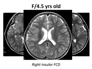 Neurology advanced mr imaging in epilepsy v lai | PDF