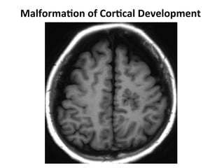 Neurology advanced mr imaging in epilepsy v lai | PDF