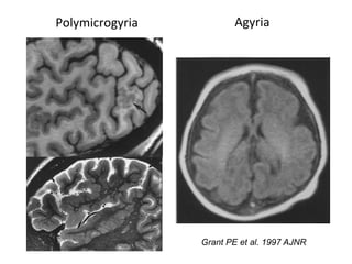 Neurology advanced mr imaging in epilepsy v lai | PDF