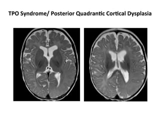 Neurology advanced mr imaging in epilepsy v lai | PDF