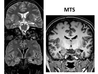 Neurology advanced mr imaging in epilepsy v lai | PDF