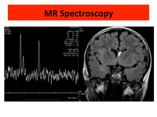 Neurology advanced mr imaging in epilepsy v lai | PDF