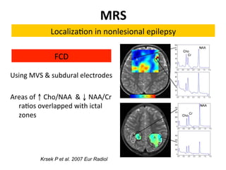 Neurology advanced mr imaging in epilepsy v lai | PDF