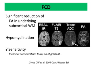 Neurology advanced mr imaging in epilepsy v lai | PDF