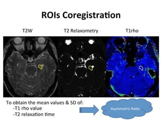 Neurology advanced mr imaging in epilepsy v lai | PDF