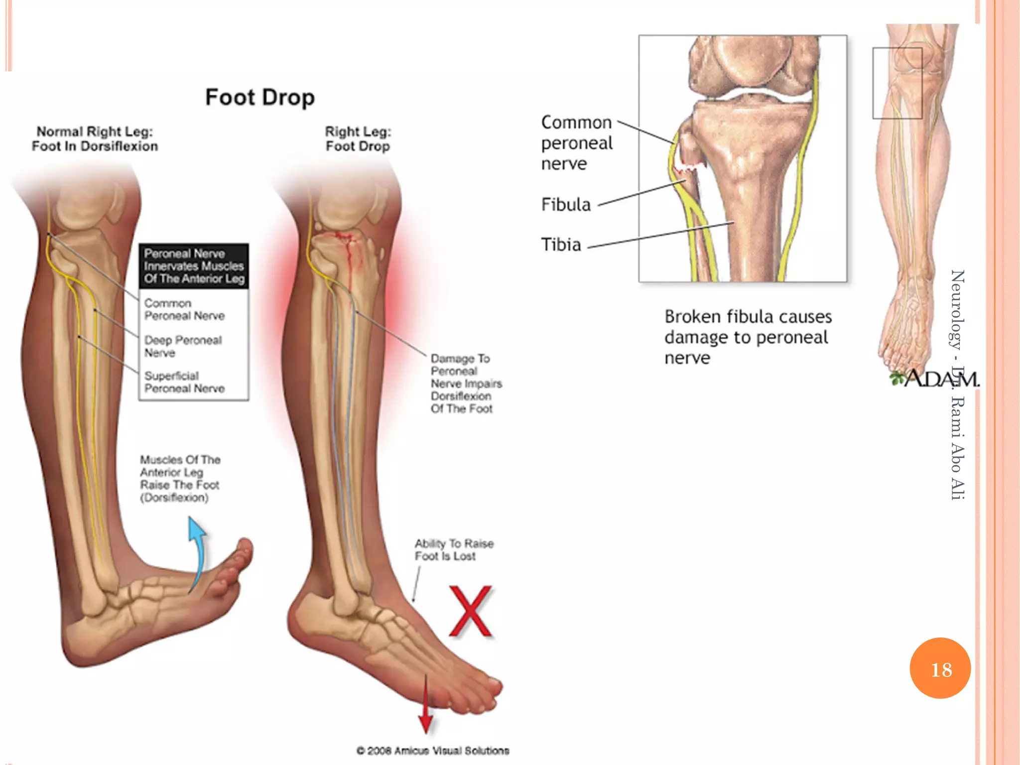18
Neurology
-
Dr.
Rami
Abo
Ali
 