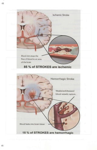 48
48
Blood clot stops Lhe
now of blood to an area
ofthe brain
lschemic Stroke
85 % of STROKES are ischemic
i .,
)(

Blood leaks into brain tissue
Hemorrhagic Stroke
Weakened/diseased
blood vessels rupture.
15 °/o of STROKES are hemorrhagic
 