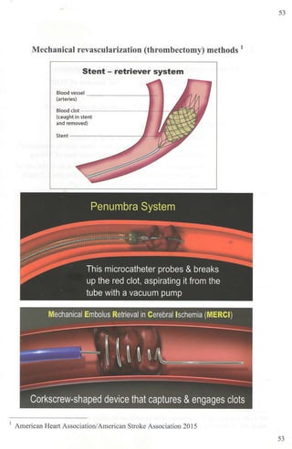 Mechanical revascularization (thrombectomy) methods 1
Stent - retriever system
Blood vessel ..._................................... ...
(arteries)
Blood clot •·······································••
(caught in stent
and removed)
Stent·············································
Penumbra System
This microcatheter probes & breaks
up the red clot, aspirating it from the
tube with a vacuum pump
Mechanical Embolus Retrieval in Cerebral lschemia (MERCI)
Corkscrew-shaped device that captures &engages clots
1
American Hea11 Association/American Stroke Association 2015
53
53
 