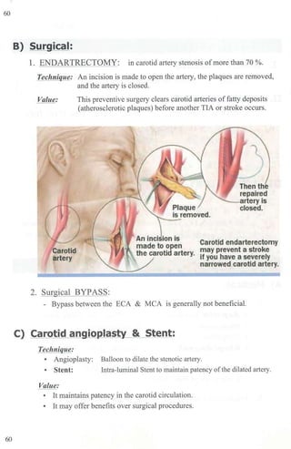 60
60
B) Surgical:
1. ENDARTRECTOMY: in carotid artery stenosis ofmore than 70 %.
Technique: An incision is made to open the artery, the plaques are removed,
and the artery is closed.
Value: This preventive sw·gery clears carotid arteries of fatty deposits
(atherosclerotic plaques) before another TIA or stroke occurs.
Carotid
artery
2. Surgical BYPASS:
1
Carotid endarterectom,y
may prelent a stroke
if you have a severely
narrowed caroftd airtery~
- Bypass between the ECA & MCA is generally not beneficial.
C) Carotid angioplasty & Stent:
Technique:
• Angioplasty: Balloon to dilate the stenotic artery.
• Stent: Intra-luminal Stent to maintain patency ofthe dilated artery.
Value:
• It maintains patency in the carotid circulation.
• It may offer benefits over surgical procedures.
 