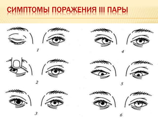 СИМПТОМЫ ПОРАЖЕНИЯ III ПАРЫ
 