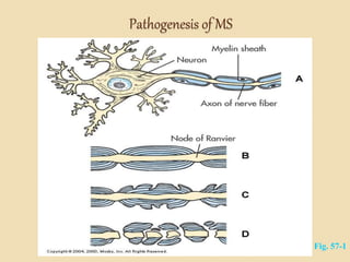 Pathogenesis of MS
Fig. 57-1
 
