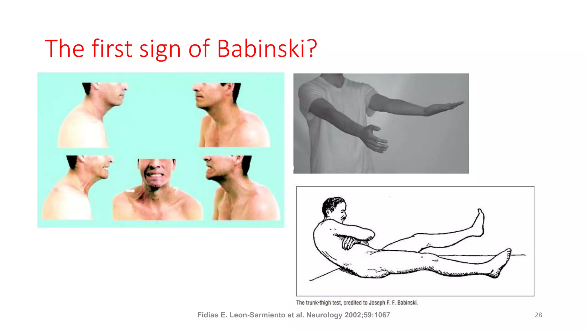The first sign of Babinski?
Fidias E. Leon-Sarmiento et al. Neurology 2002;59:1067 28
 