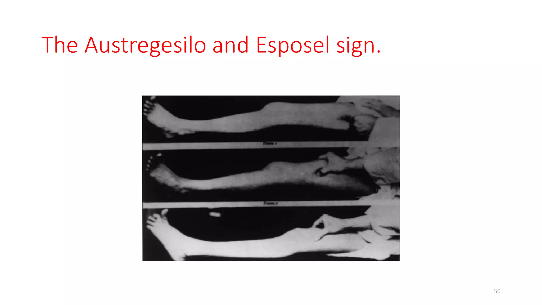 The Austregesilo and Esposel sign.
30
 