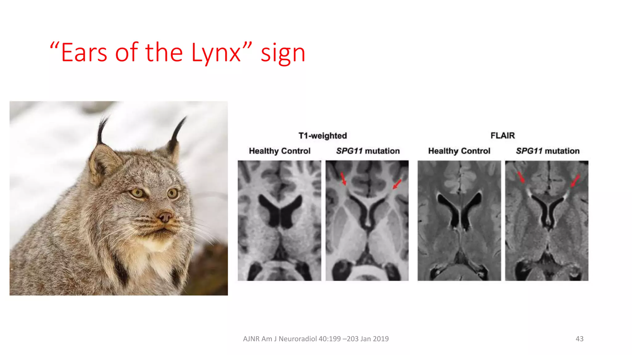 “Ears of the Lynx” sign
AJNR Am J Neuroradiol 40:199 –203 Jan 2019 43
 
