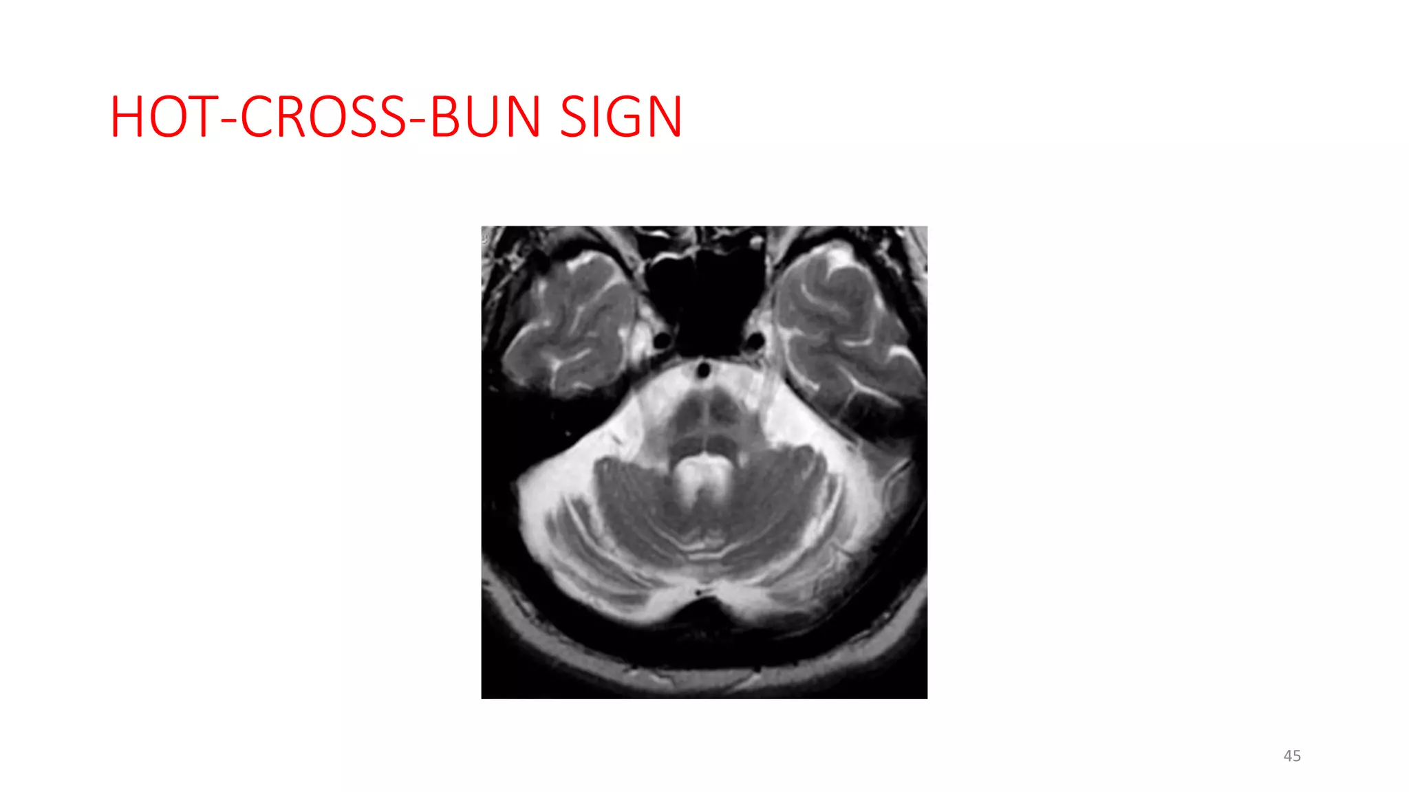 HOT-CROSS-BUN SIGN
45
 