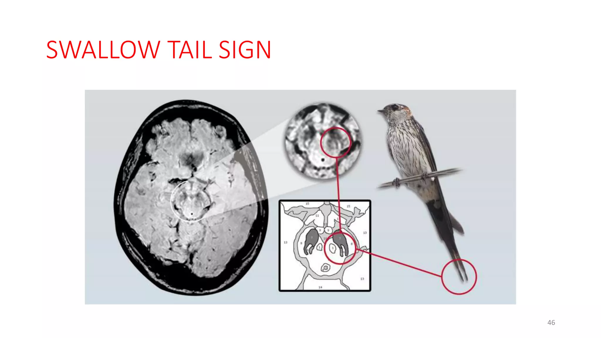 SWALLOW TAIL SIGN
46
 