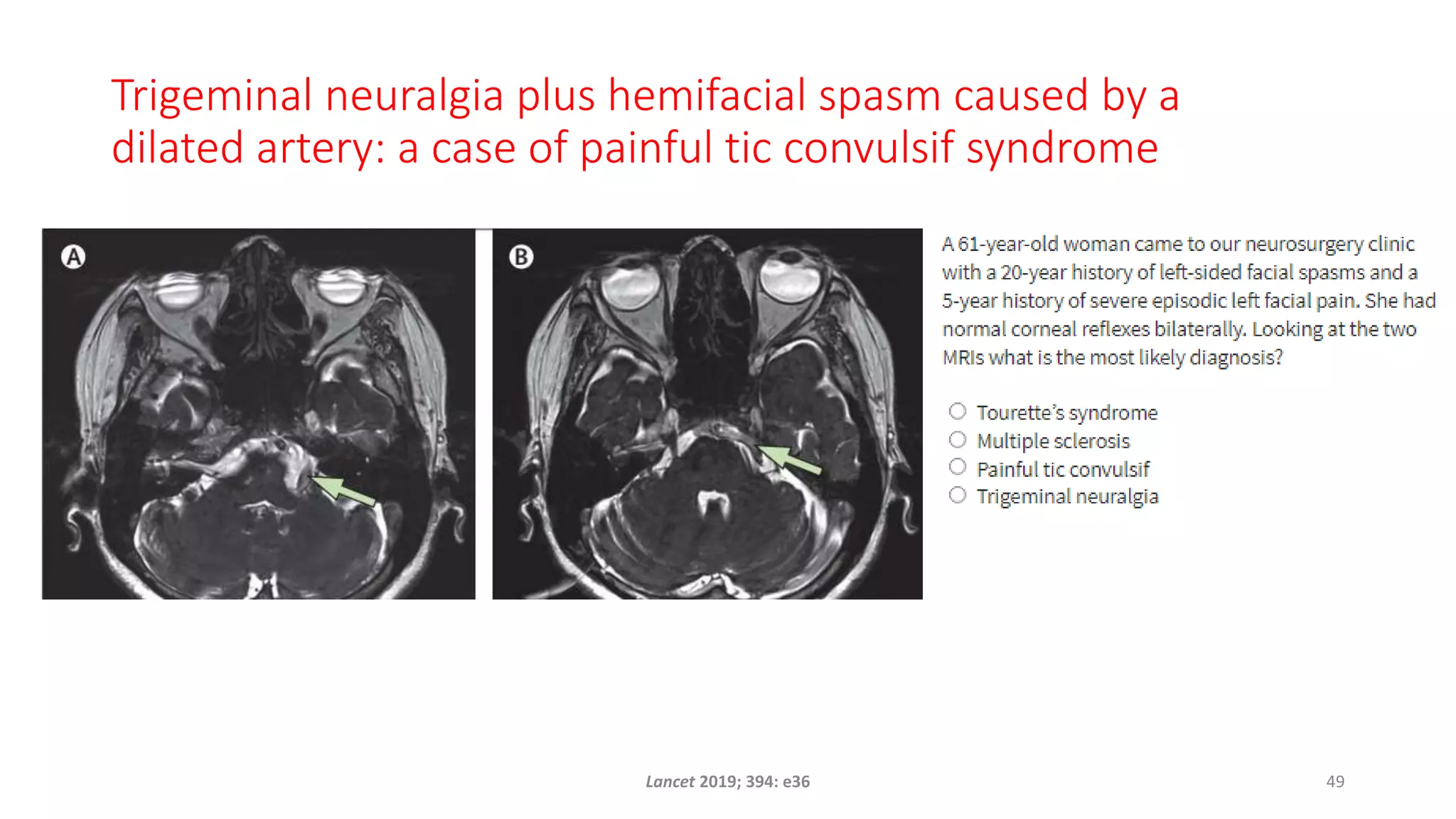 Trigeminal neuralgia plus hemifacial spasm caused by a
dilated artery: a case of painful tic convulsif syndrome
Lancet 2019; 394: e36 49
 