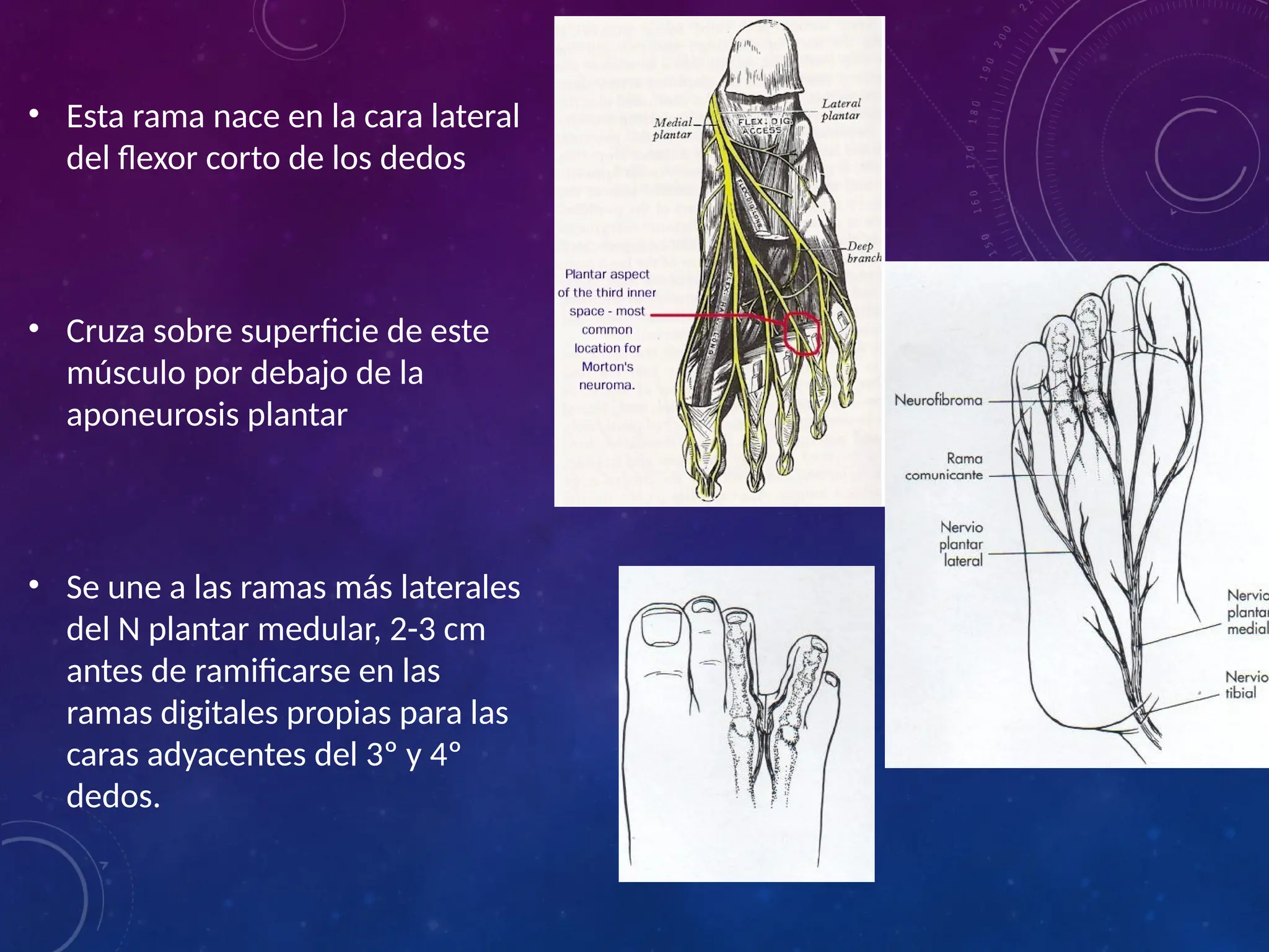 Neuroma interdigital o neuroma de Morton.pptx