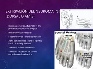 Neuroma interdigital o neuroma de Morton.pptx
