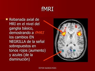 fMRI Rebanada axial de MRI en el nivel del ganglia básico, demostrando a  fMRI  los cambios EN NEGRILLA de la señal sobrepuestos en tonos rojos (aumento) y azules (de la disminución)   