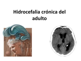 Hidrocefalia crónica del
adulto
 